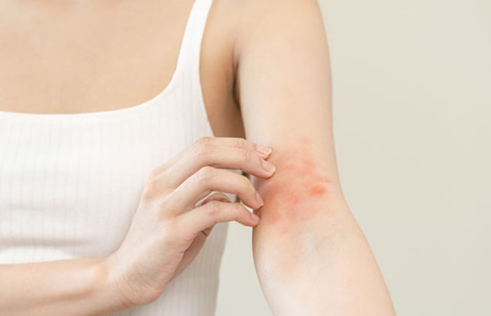 Eczema Treatment