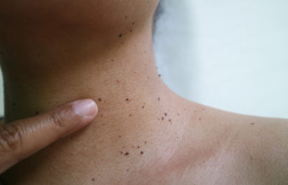 Skin Tag Removal Cape Town